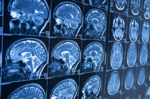 How Our Escondido Personal Injury Lawyers Can Help Brain Injury Victims Like You 